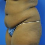 Buttock Shaping (Brazilian Butt Lift)