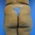 Buttock Shaping (Brazilian Butt Lift)