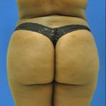 Buttock Shaping (Brazilian Butt Lift)