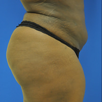 Buttock Shaping (Brazilian Butt Lift) Case 2810 After Photo Buttock Shaping (Brazilian Butt Lift)