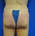 Buttock Shaping (Brazilian Butt Lift)