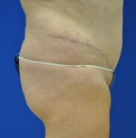 Buttock Shaping (Brazilian Butt Lift)