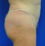 Buttock Shaping (Brazilian Butt Lift)
