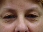 Eyelid Surgery