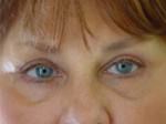 Eyelid Surgery