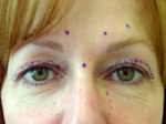 Eyelid Surgery