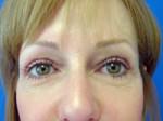 Eyelid Surgery