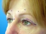 Eyelid Surgery