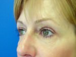 Eyelid Surgery