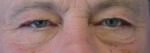 Eyelid Surgery