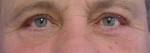 Eyelid Surgery