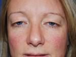 Eyelid Surgery