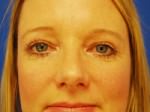 Eyelid Surgery
