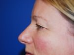 Eyelid Surgery