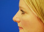 Eyelid Surgery
