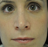 Rhinoplasty Case 2970 After Photo Rhinoplasty