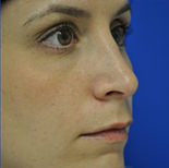 Rhinoplasty Case 2970 After Photo Rhinoplasty