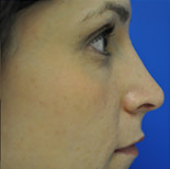 Rhinoplasty Case 2970 After Photo Rhinoplasty