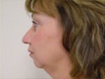 Chin and Cheek Implants