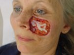Facial Reconstructive Surgery