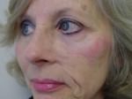 Facial Reconstructive Surgery
