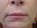 Fat Transfer