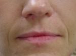 Lip Augmentation