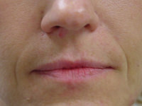 Lip Augmentation Case 3038 Before Photo Lip Augmentation