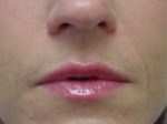 Lip Augmentation