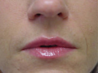 Lip Augmentation Case 3038 After Photo Lip Augmentation