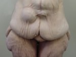 Body, Thigh, and Arm Lifts