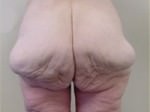 Body, Thigh, and Arm Lifts