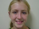 Otoplasty