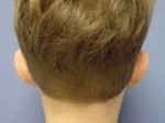Otoplasty