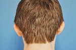 Otoplasty