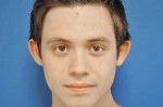 Otoplasty