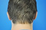 Otoplasty