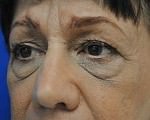 Eyelid Surgery