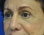 Eyelid Surgery