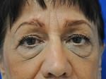 Eyelid Surgery