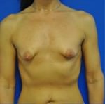 Complex Primary Breast Augmentation