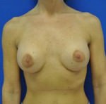 Complex Primary Breast Augmentation