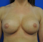 Revisional & Corrective Breast Augmentation