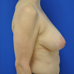 Breast Lift / Mastopexy