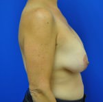 Breast Lift / Mastopexy