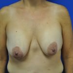 Breast Lift / Mastopexy