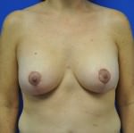 Breast Lift / Mastopexy