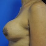 Revisional & Corrective Breast Augmentation