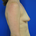 Complex Primary Breast Augmentation