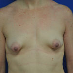 Complex Primary Breast Augmentation